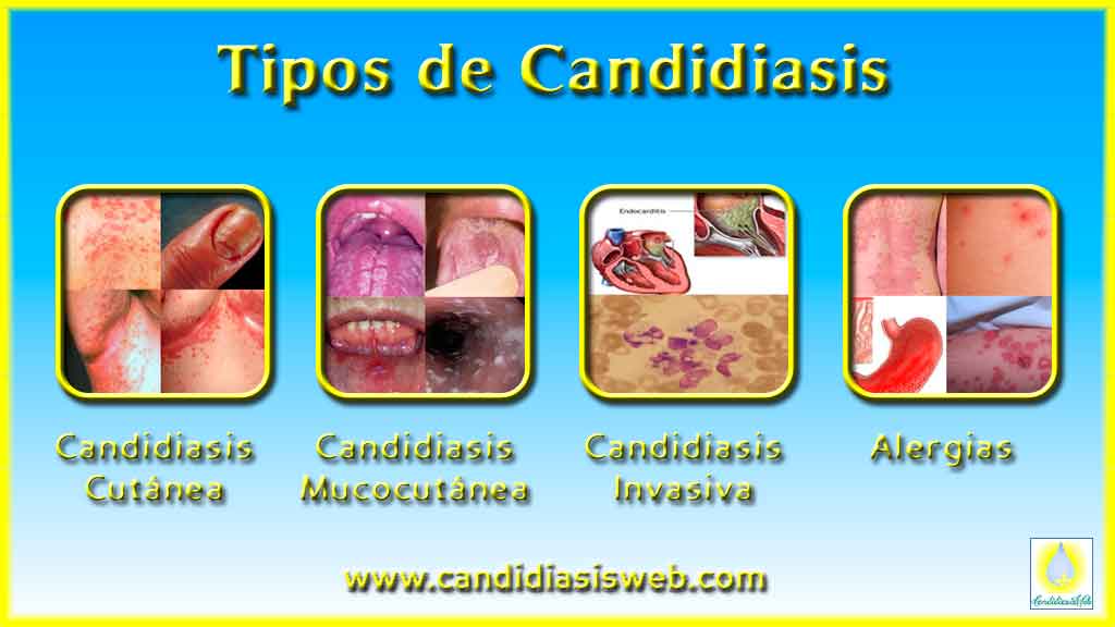 Los medios del hongo con levadura del intestino