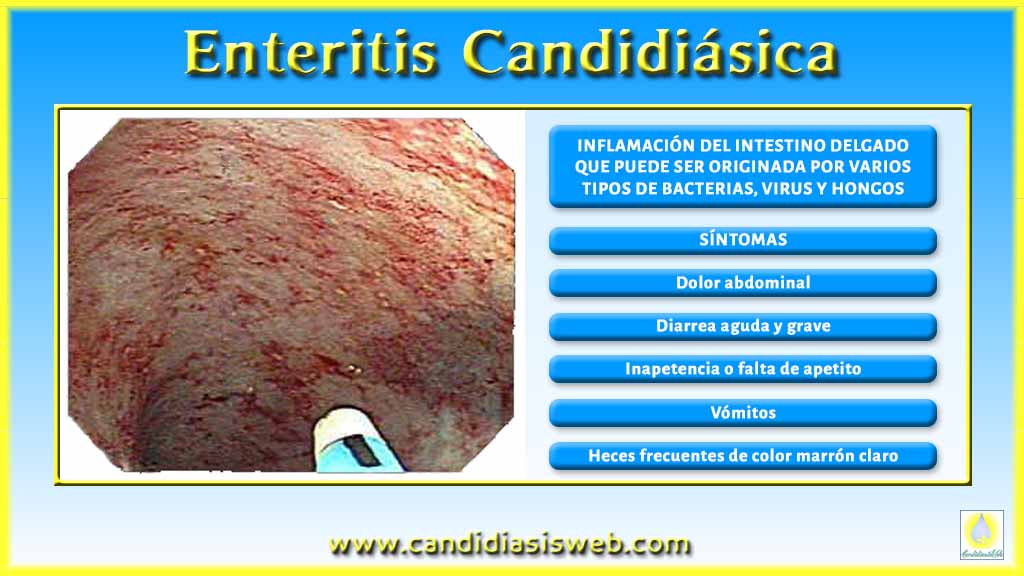 La psoriasis el tratamiento del ungüento dayvoneks