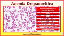 Anemia Drepanocítica