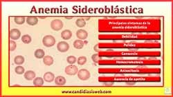 Anemia Sideroblástica