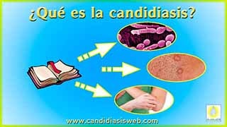 Candidiasis
