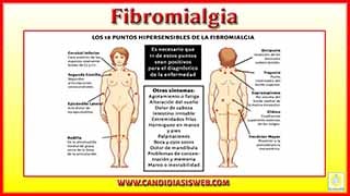 Fibromialgia