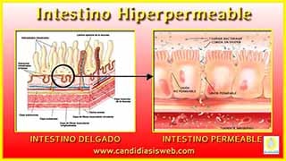 Intestino Hiperpermeable