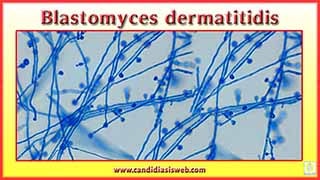 Blastomyces dermatitidis
