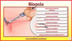 Biopsia