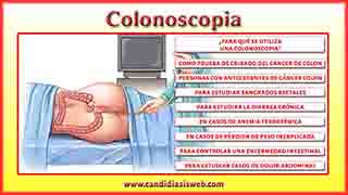 Colonoscopia