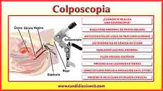 Colposcopia
