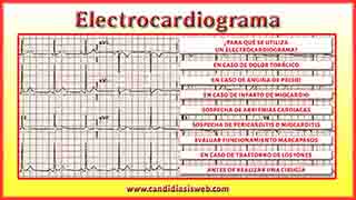 Electrocardiograma