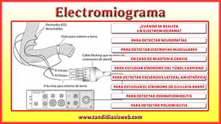 Electromiograma