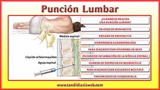 Punción lumbar