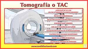 Tomografía o TAC