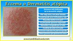 Eccema o Dermatitis atópica