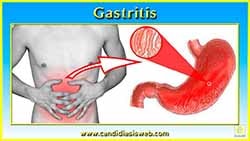 Gastritis