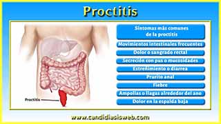 Proctitis