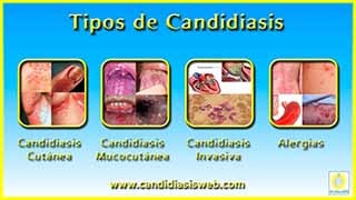 Tipos de Candidiasis