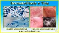 Dermatofitosis