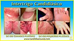 Intertrigo Candidiásico