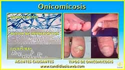 Onicomicosis