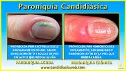 Paroniquia Candidiásica