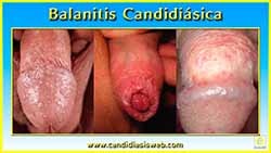 Balanitis Candidiásica