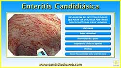 Enteritis Candidiásica