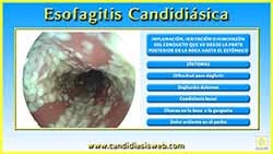 Esofagitis Candidiásica