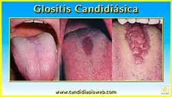 Glositis Candidiásica