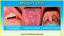 Muguet Oral