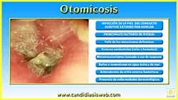 Otomicosis