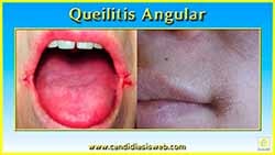 Queilitis Angular