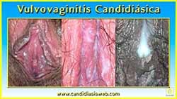 Vulvovaginitis Candidiásica