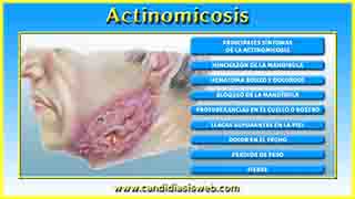 Actinomicosis