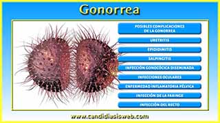 Gonorrea