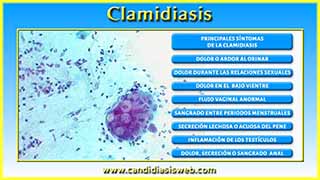 Clamidiasis