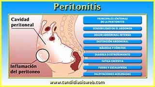 Peritonitis