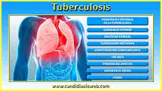 Tuberculosis