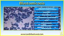 Blastomicosis