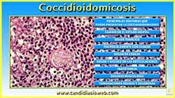 Coccidioidomicosis