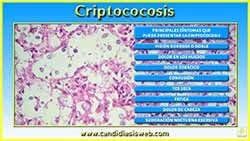 Criptococosis