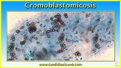 Cromoblastomicosis