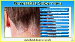Dermatitis Seborreica