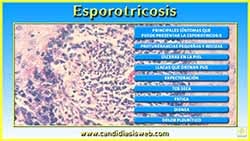 Esporotricosis