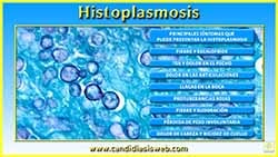 Histoplasmosis