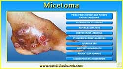 Micetoma