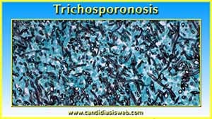 Trichosporonosis