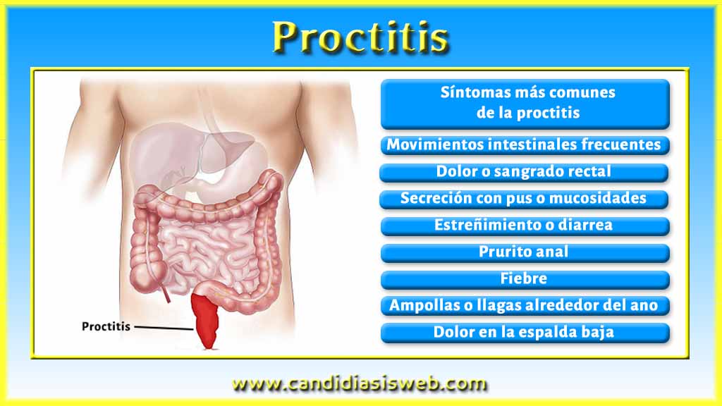 Otros Síntomas - Proctitis